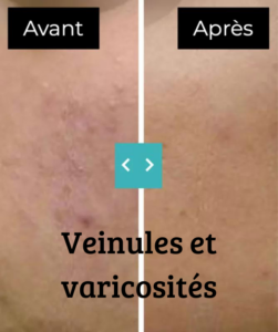 Veinules et varicosités avant et aprèss